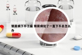 银屑病下不了床 银屑病犯了一直下不去怎么办