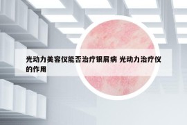 光动力美容仪能否治疗银屑病 光动力治疗仪的作用