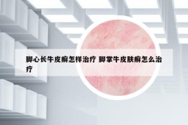 脚心长牛皮癣怎样治疗 脚掌牛皮肤癣怎么治疗