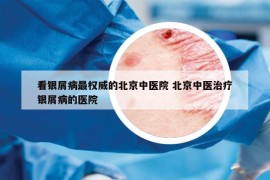 看银屑病最权威的北京中医院 北京中医治疗银屑病的医院