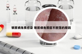 银屑病角质感染 银屑病角质层不脱落的原因