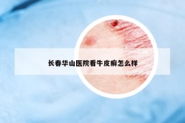 长春华山医院看牛皮癣怎么样