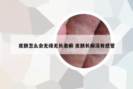 皮肤怎么会无缘无长悬癣 皮肤长癣没有感觉