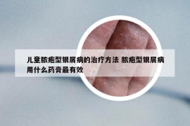 儿童脓疱型银屑病的治疗方法 脓疱型银屑病用什么药膏最有效