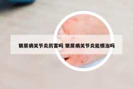 银屑病关节炎厉害吗 银屑病关节炎能根治吗