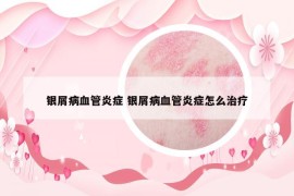 银屑病血管炎症 银屑病血管炎症怎么治疗