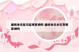 扁桃体炎能引起银屑病吗 扁桃体炎会引发银屑病吗