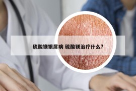 硫酸镁银屑病 硫酸镁治疗什么?