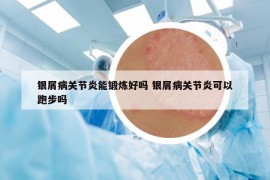 银屑病关节炎能锻炼好吗 银屑病关节炎可以跑步吗