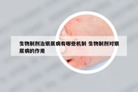 生物制剂治银屑病有哪些机制 生物制剂对银屑病的作用