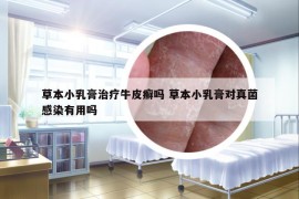 草本小乳膏治疗牛皮癣吗 草本小乳膏对真菌感染有用吗