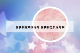 皮肤癣应如何治疗 皮肤癣怎么治疗啊