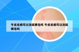 牛皮皮癣可以洗硫磺皂吗 牛皮皮癣可以洗硫磺皂吗