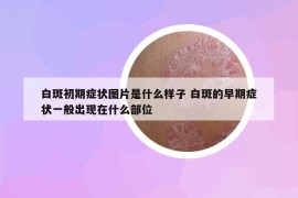 白斑初期症状图片是什么样子 白斑的早期症状一般出现在什么部位