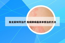 股足藓如何治疗 股癣脚癣最简单根治的方法