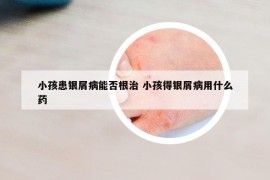 小孩患银屑病能否根治 小孩得银屑病用什么药