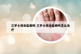 三岁小孩会起癣吗 三岁小孩会起癣吗怎么治疗