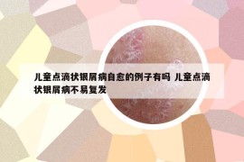 儿童点滴状银屑病自愈的例子有吗 儿童点滴状银屑病不易复发