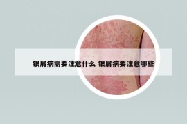 银屑病需要注意什么 银屑病要注意哪些