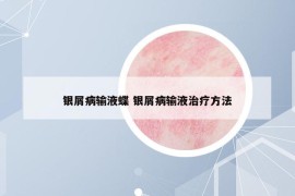 银屑病输液蝶 银屑病输液治疗方法