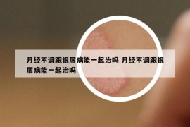 月经不调跟银屑病能一起治吗 月经不调跟银屑病能一起治吗