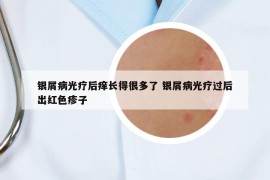 银屑病光疗后痒长得很多了 银屑病光疗过后出红色疹子