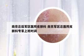 南京总后军区医院皮肤科 南京军区总医院皮肤科专家上班时间