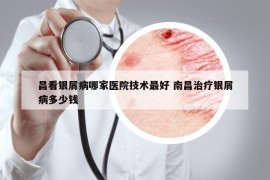 昌看银屑病哪家医院技术最好 南昌治疗银屑病多少钱