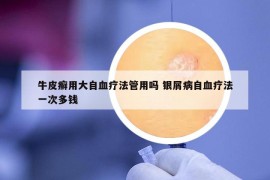 牛皮癣用大自血疗法管用吗 银屑病自血疗法一次多钱