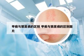 甲癣与银屑病的区别 甲癣与银屑病的区别图片