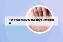 广西牛皮癣民间秘方 民间治疗牛皮病癣的偏方