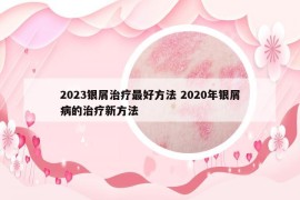 2023银屑治疗最好方法 2020年银屑病的治疗新方法