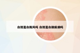 白斑是白殿风吗 白斑是白颠疯病吗