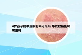 4岁孩子的牛皮癣能喝可乐吗 牛皮肤癣能喝可乐吗