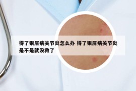 得了银屑病关节炎怎么办 得了银屑病关节炎是不是就没救了