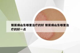 银屑病山东哪里治疗的好 银屑病山东哪里治疗的好一点