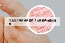 专业治疗银屑病的医院 专治银屑病的医院哪里