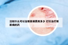 注射什么可以治银屑病费用多少 打针治疗银屑病的药