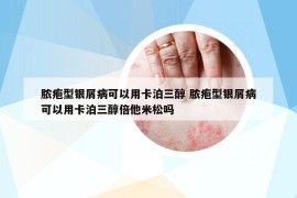 脓疱型银屑病可以用卡泊三醇 脓疱型银屑病可以用卡泊三醇倍他米松吗