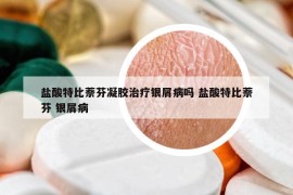 盐酸特比萘芬凝胶治疗银屑病吗 盐酸特比萘芬 银屑病