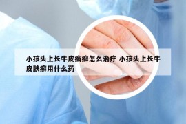 小孩头上长牛皮癣癣怎么治疗 小孩头上长牛皮肤癣用什么药