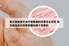 复方氨肽素片治疗银屑病的效果怎么样呢 复方氨肽素片和银屑颗粒哪个效果好