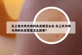 头上有大块大块的头皮癣怎么办 头上长大块大块的头皮屑是怎么回事?