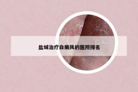 盐城治疗白癜风的医院排名