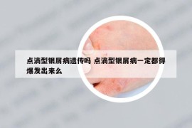 点滴型银屑病遗传吗 点滴型银屑病一定都得爆发出来么