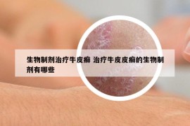 生物制剂治疗牛皮癣 治疗牛皮皮癣的生物制剂有哪些