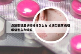 点滴型银屑病咽喉痛怎么办 点滴型银屑病咽喉痛怎么办缓解