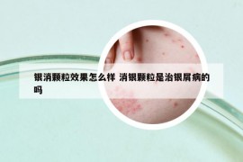 银消颗粒效果怎么样 消银颗粒是治银屑病的吗