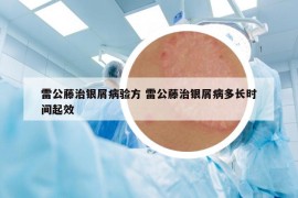 雷公藤治银屑病验方 雷公藤治银屑病多长时间起效