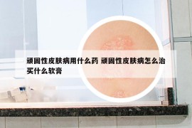 顽固性皮肤病用什么药 顽固性皮肤病怎么治买什么软膏